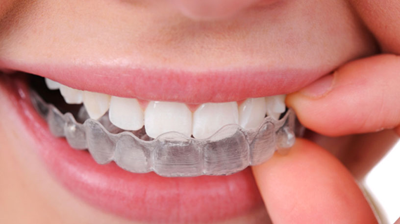 The Five Reasons Why Invisalign Is Great For Adults